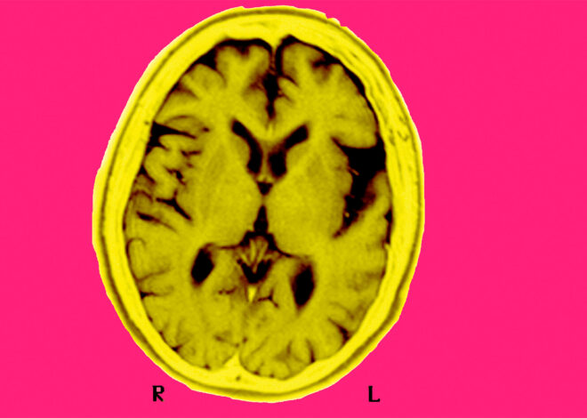 UCSF studies blood test for cognitive impairment: ‘Floodgates are about to open’