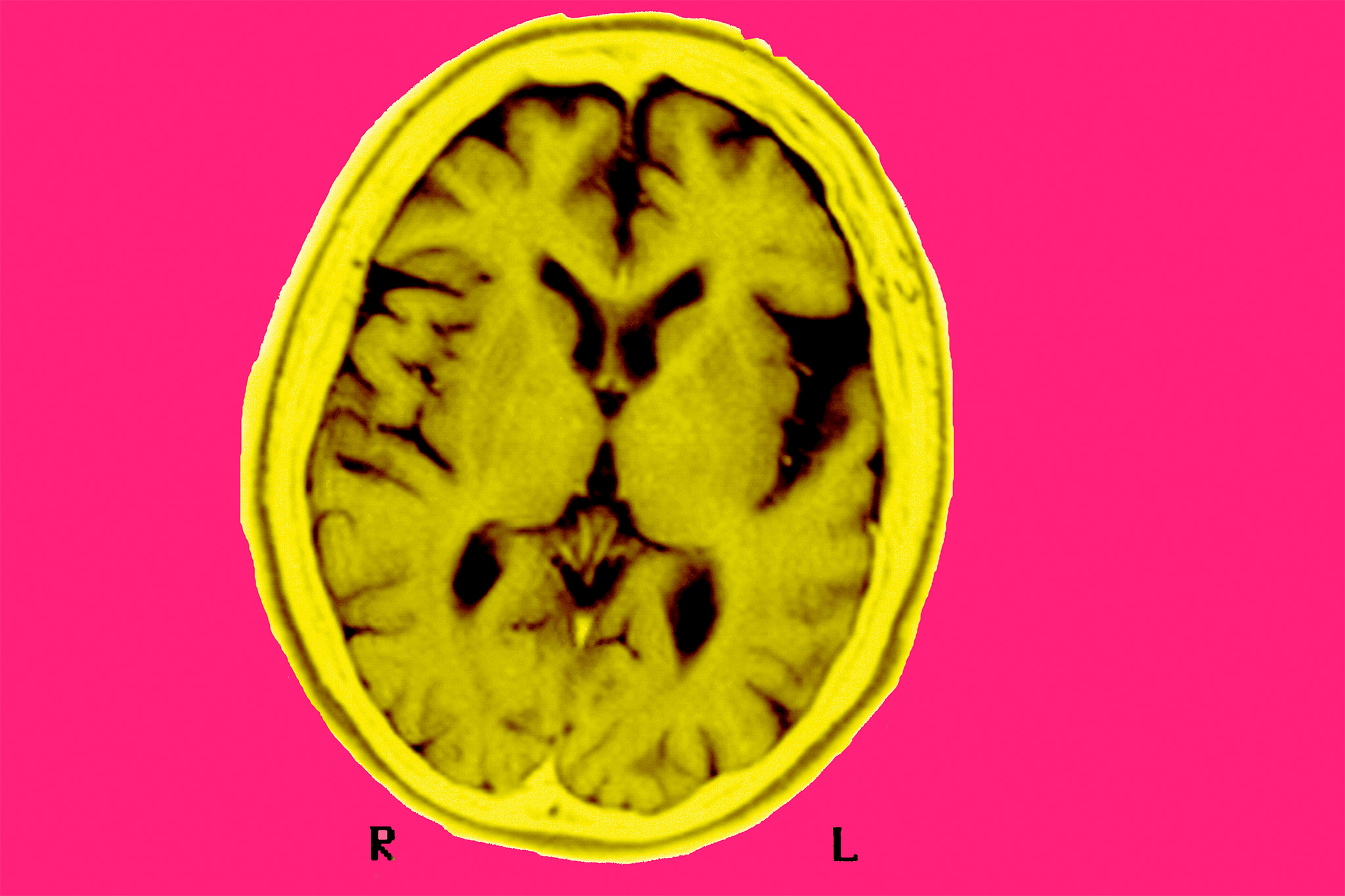 UCSF studies blood test for cognitive impairment: ‘Floodgates are about to open’