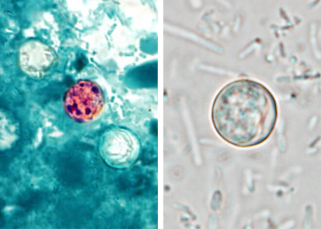 A parasitic infection has hit new highs in the U.S., why Calif. has been spared