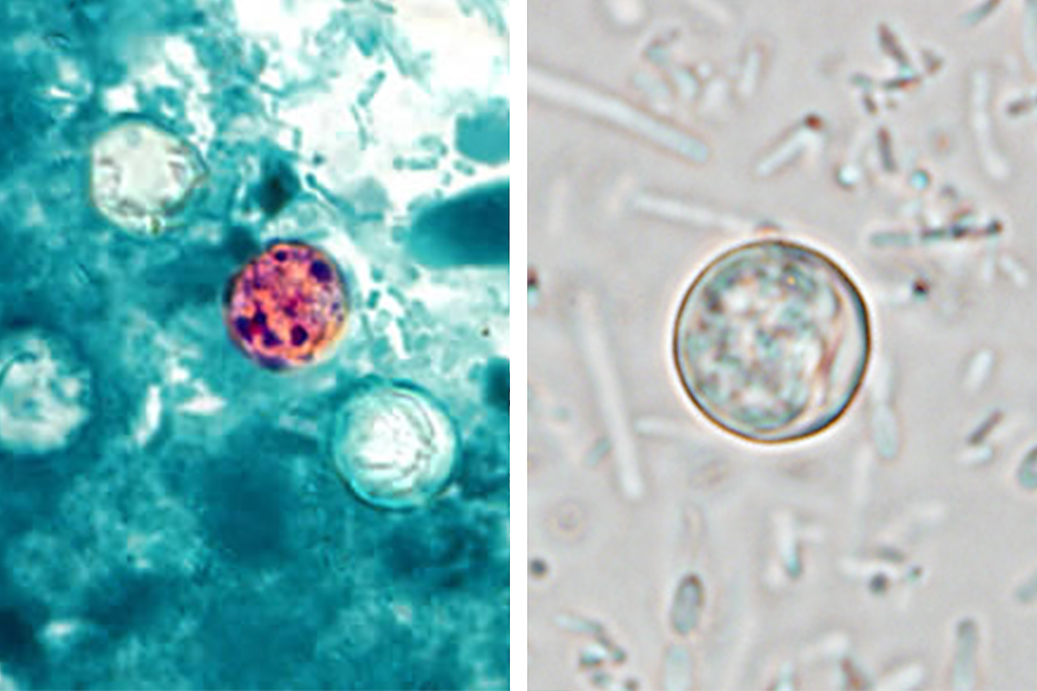 A parasitic infection has hit new highs in the U.S., why Calif. has been spared